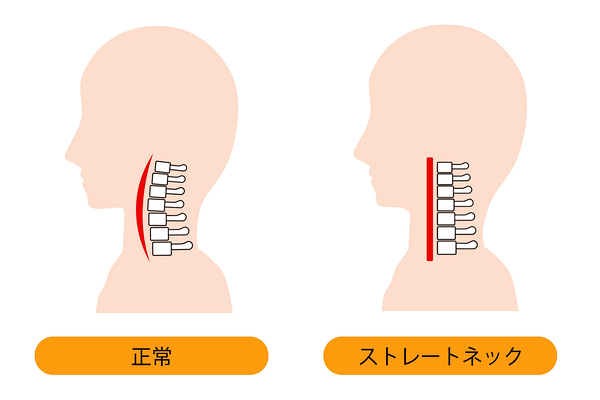 正常な椎骨とストレートネックになってしまった際の椎骨
