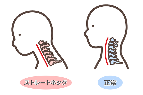 スマホ首とは 画像