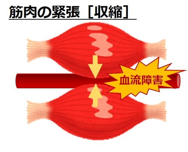 筋膜リリース療法について 画像